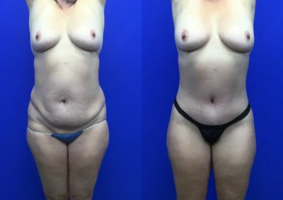 Plus Size Body Contouring before and after photos by Cabbabe Plastic Surgery in Saint Louis, MO