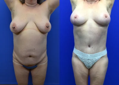 Plus Size Body Contouring before and after photos by Cabbabe Plastic Surgery in Saint Louis, MO