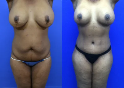 Plus Size Body Contouring before and after photos by Cabbabe Plastic Surgery in Saint Louis, MO