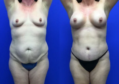 Plus Size Body Contouring before and after photos by Cabbabe Plastic Surgery in Saint Louis, MO