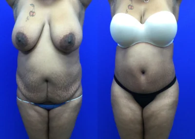 Plus Size Body Contouring before and after photos by Cabbabe Plastic Surgery in Saint Louis, MO