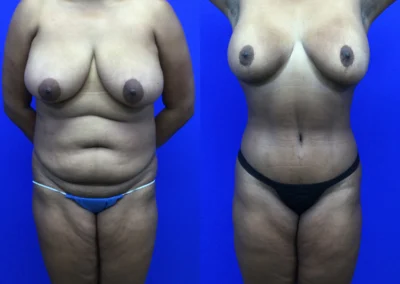Plus Size Body Contouring before and after photos by Cabbabe Plastic Surgery in Saint Louis, MO