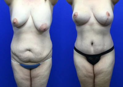 Plus Size Body Contouring before and after photos by Cabbabe Plastic Surgery in Saint Louis, MO