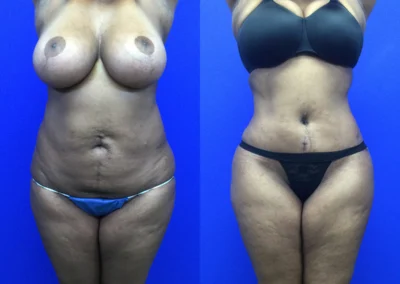 Plus Size Body Contouring before and after photos by Cabbabe Plastic Surgery in Saint Louis, MO