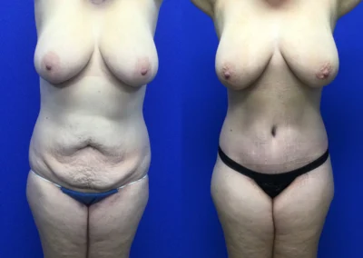 Plus Size Body Contouring before and after photos by Cabbabe Plastic Surgery in Saint Louis, MO