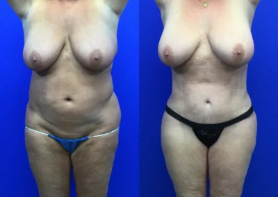 Plus Size Body Contouring before and after photos by Cabbabe Plastic Surgery in Saint Louis, MO