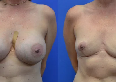 Breast Implant Removal before and after photos by Cabbabe Plastic Surgery in Saint Louis, MO