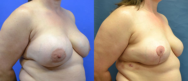 Breast Implant Removal before and after photos by Cabbabe Plastic Surgery in Saint Louis, MO