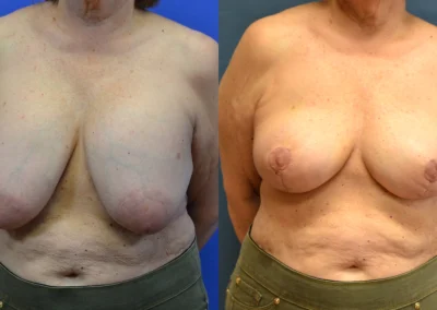Breast Implant Removal before and after photos by Cabbabe Plastic Surgery in Saint Louis, MO