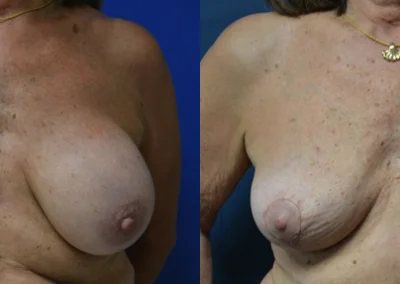 Breast Implant Removal before and after photos by Cabbabe Plastic Surgery in Saint Louis, MO