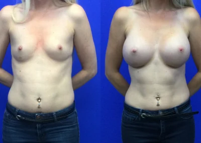 Breast Implants before and after photos by Cabbabe Plastic Surgery in Saint Louis, MO