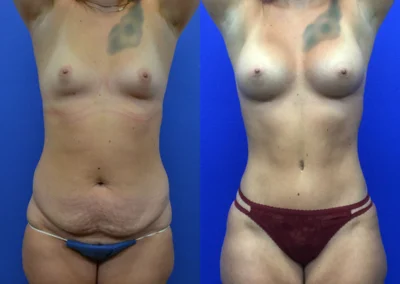 Breast Implants before and after photos by Cabbabe Plastic Surgery in Saint Louis, MO