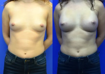 Breast Implants before and after photos by Cabbabe Plastic Surgery in Saint Louis, MO