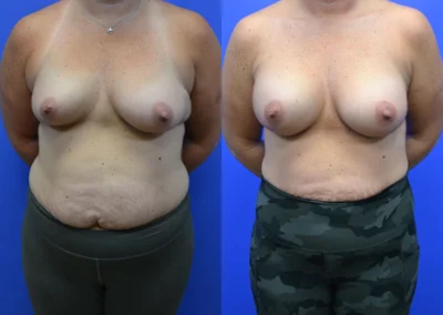 Breast Implants before and after photos by Cabbabe Plastic Surgery in Saint Louis, MO