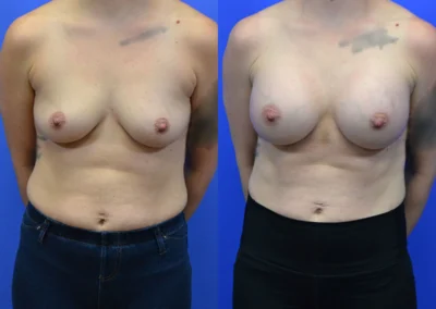 Breast Implants before and after photos by Cabbabe Plastic Surgery in Saint Louis, MO