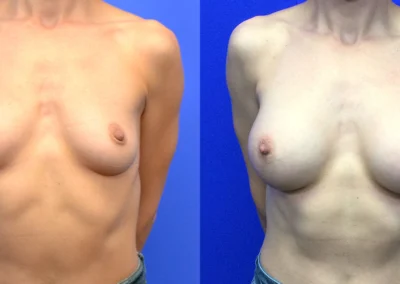 Breast Implants before and after photos by Cabbabe Plastic Surgery in Saint Louis, MO