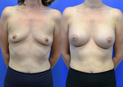 Breast Implants before and after photos by Cabbabe Plastic Surgery in Saint Louis, MO