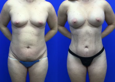 Breast Implants before and after photos by Cabbabe Plastic Surgery in Saint Louis, MO