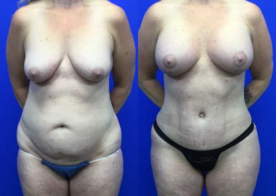 Breast Implants with Lift before and after photos by Cabbabe Plastic Surgery in Saint Louis, MO