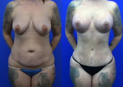 Breast Implants with Lift before and after photos by Cabbabe Plastic Surgery in Saint Louis, MO