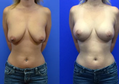 Breast Implants with Lift before and after photos by Cabbabe Plastic Surgery in Saint Louis, MO