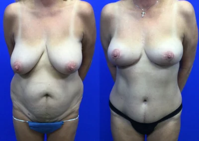 Breast Lift before and after photos by Cabbabe Plastic Surgery in Saint Louis, MO