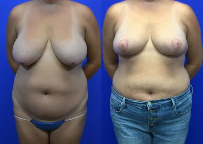Breast Lift before and after photos by Cabbabe Plastic Surgery in Saint Louis, MO