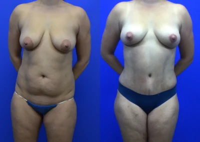 Breast Lift before and after photos by Cabbabe Plastic Surgery in Saint Louis, MO