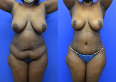 Breast Lift before and after photos by Cabbabe Plastic Surgery in Saint Louis, MO