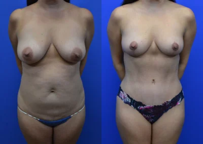 Breast Lift before and after photos by Cabbabe Plastic Surgery in Saint Louis, MO