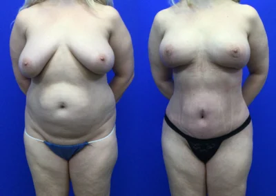 Breast Lift before and after photos by Cabbabe Plastic Surgery in Saint Louis, MO
