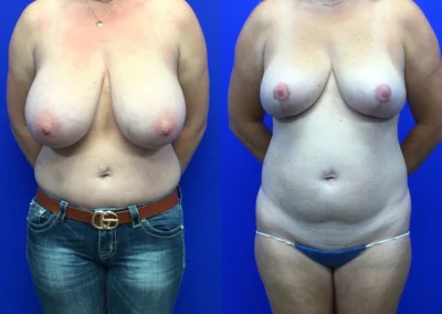 Breast Reduction before and after photos by Cabbabe Plastic Surgery in Saint Louis, MO
