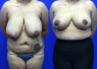 Breast Reduction before and after photos by Cabbabe Plastic Surgery in Saint Louis, MO
