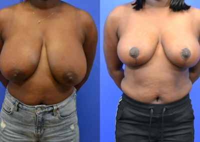Breast Reduction before and after photos by Cabbabe Plastic Surgery in Saint Louis, MO