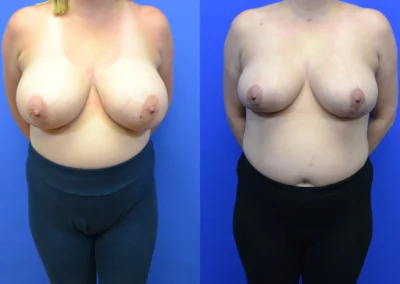 Breast Reduction before and after photos by Cabbabe Plastic Surgery in Saint Louis, MO