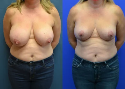 Breast Reduction before and after photos by Cabbabe Plastic Surgery in Saint Louis, MO