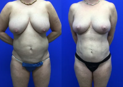 Breast Lift with Fat Transfer before and after photos by Cabbabe Plastic Surgery in Saint Louis, MO