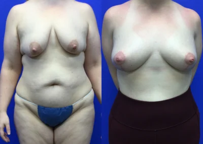 Breast Lift with Fat Transfer before and after photos by Cabbabe Plastic Surgery in Saint Louis, MO