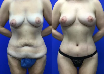 Breast Lift with Fat Transfer before and after photos by Cabbabe Plastic Surgery in Saint Louis, MO