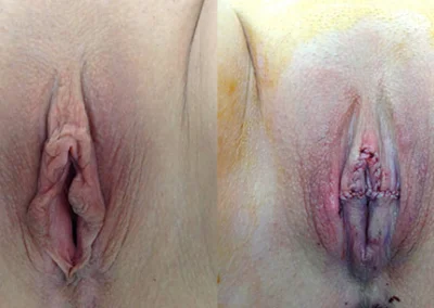 Labiaplasty before and after photos by Cabbabe Plastic Surgery in Saint Louis, MO