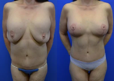 Revision Breast Surgery before and after photos by Cabbabe Plastic Surgery in Saint Louis, MO