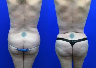 Fat Transfer Hip Dips before and after photos by Cabbabe Plastic Surgery in Saint Louis, MO