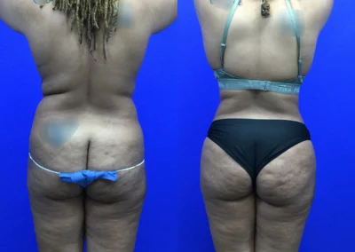 Fat Transfer Hip Dips before and after photos by Cabbabe Plastic Surgery in Saint Louis, MO
