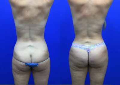 Fat Transfer Hip Dips before and after photos by Cabbabe Plastic Surgery in Saint Louis, MO
