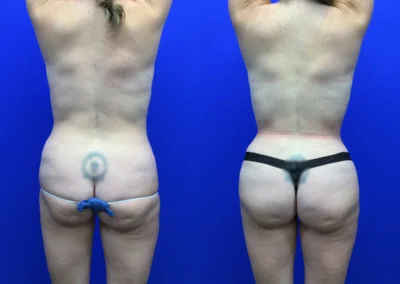 Fat Transfer Hip Dips before and after photos by Cabbabe Plastic Surgery in Saint Louis, MO