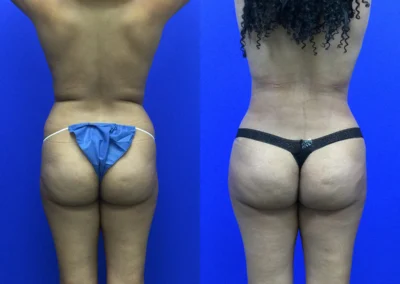 Fat Transfer Hip Dips before and after photos by Cabbabe Plastic Surgery in Saint Louis, MO