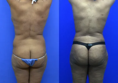 Fat Transfer Hip Dips before and after photos by Cabbabe Plastic Surgery in Saint Louis, MO