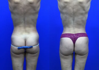 Fat Transfer Hip Dips before and after photos by Cabbabe Plastic Surgery in Saint Louis, MO