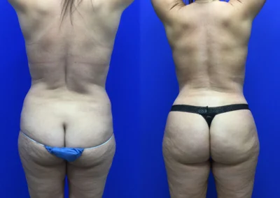 Fat Transfer Hip Dips before and after photos by Cabbabe Plastic Surgery in Saint Louis, MO