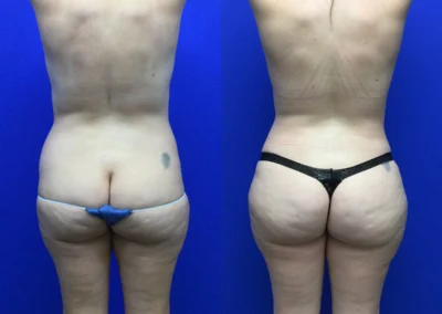 Fat Transfer Hip Dips before and after photos by Cabbabe Plastic Surgery in Saint Louis, MO
